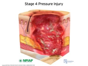 Stage 4 NPIAP
Pressure Sore Injury