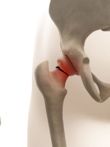 Hip Fracture and Other Fall Related Injuries