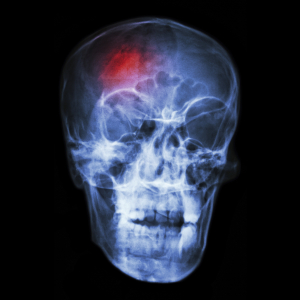 Subdural Hematoma Head Injury